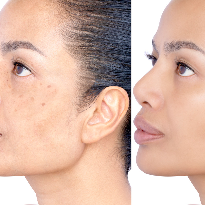 Hyperpigmentation & Dark Spots