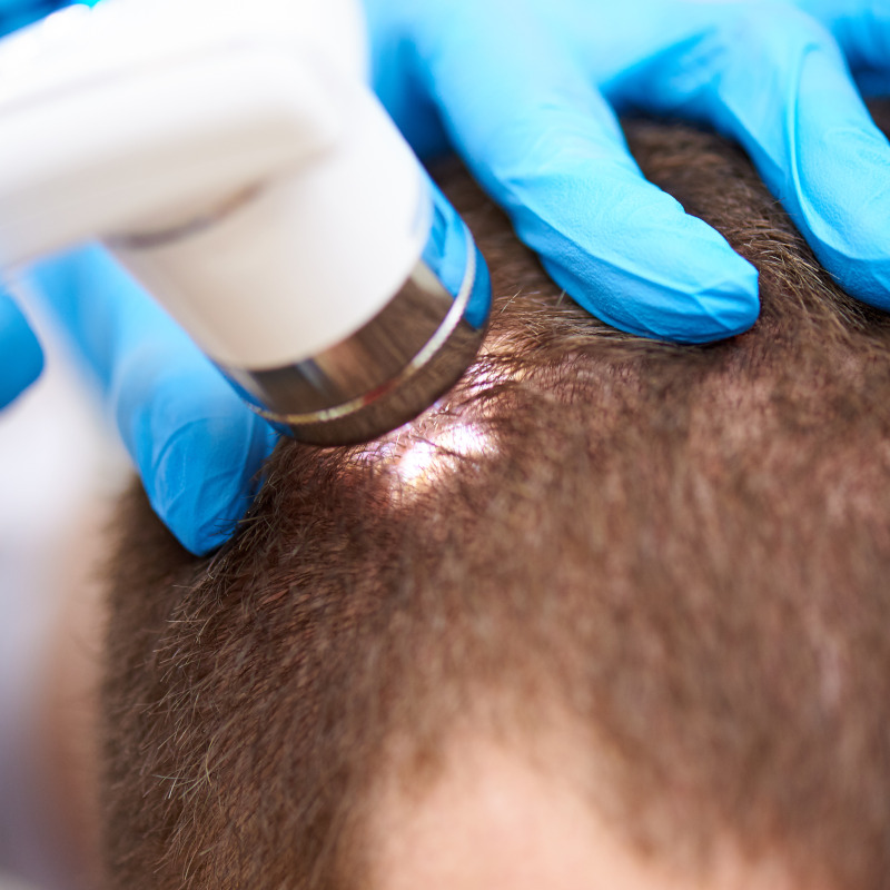 Trichoscopic Hair Analysis